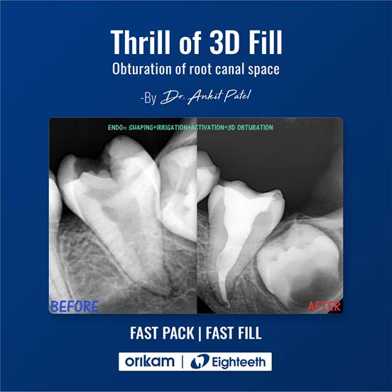 3D熱牙膠充填系統，眾多網友的使用評價